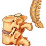 Afectiuni ale coloanei vertebrale si felul in care acestea se rasfrang asupra intregului organism