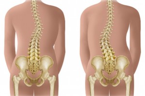 Deviatiile patologice ale coloanei vertebrale | Afectiuni scolioza | Scolioze